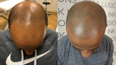 FAQs About Scalp Micropigmentation Ink