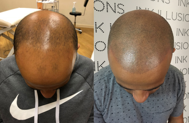 FAQs About Scalp Micropigmentation Ink