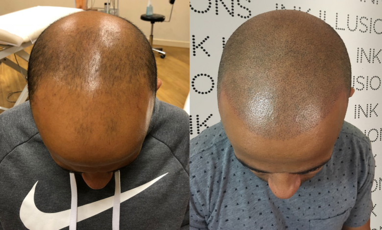 FAQs About Scalp Micropigmentation Ink