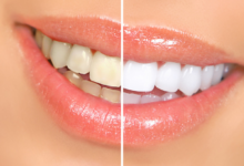 How to Limit Teeth Whitening