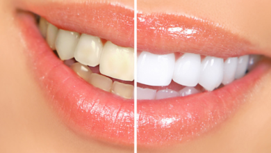 How to Limit Teeth Whitening