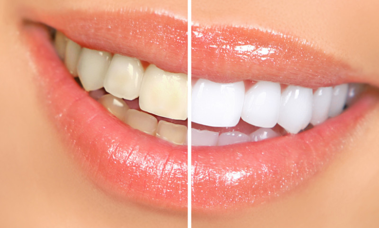 How to Limit Teeth Whitening